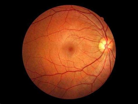 Retina dekolmanı ve diyabet
